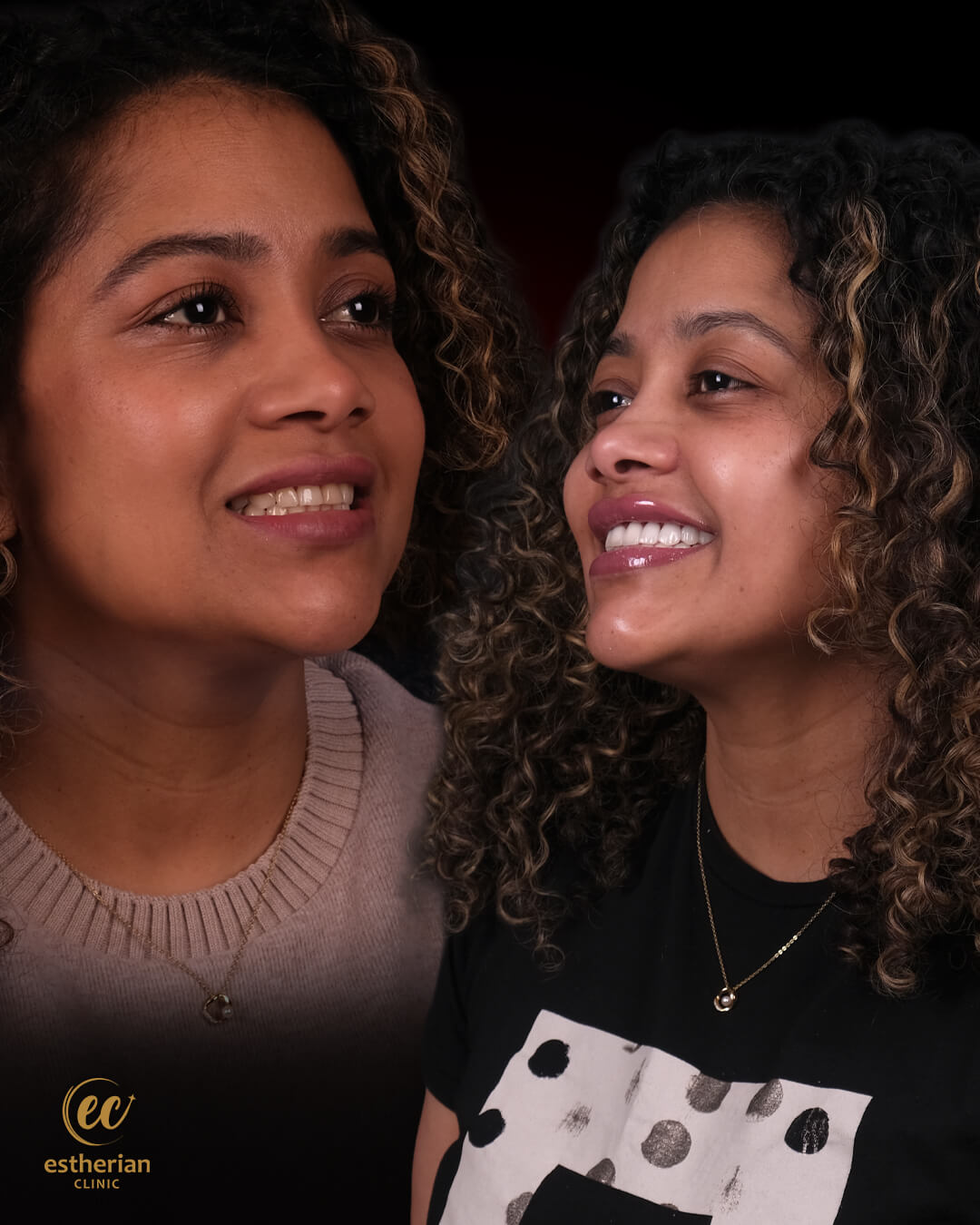 Smile Makeover Before After 1