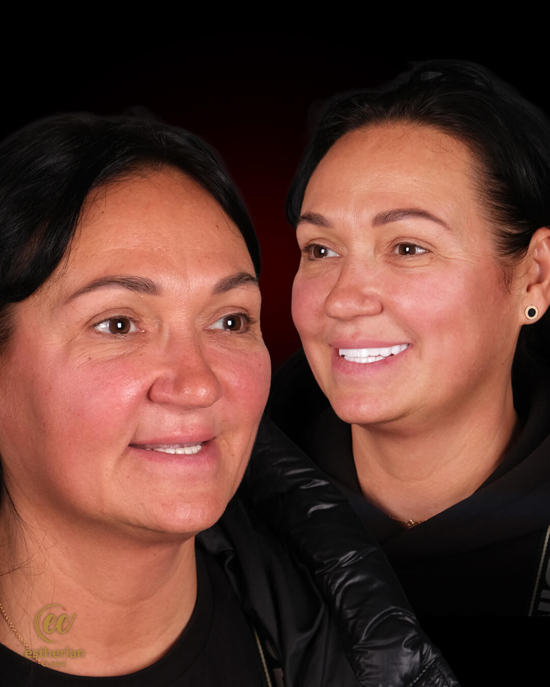 Smile Makeover Before After 2