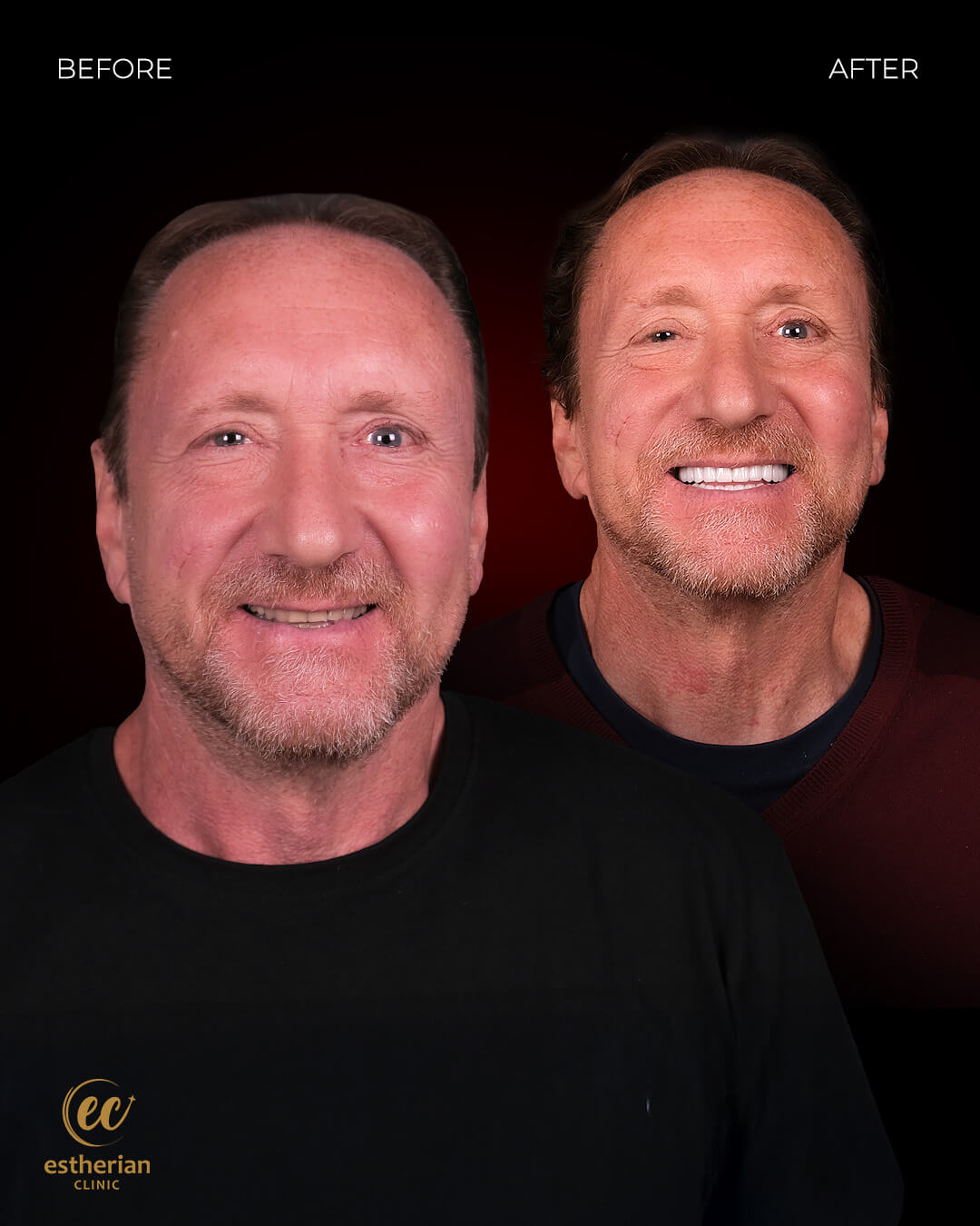 Smile Makeover Before After 3