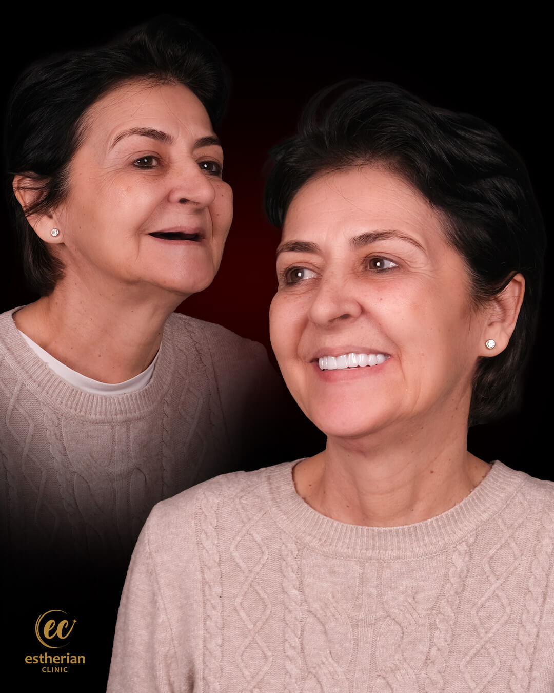 Smile Makeover Before After 4