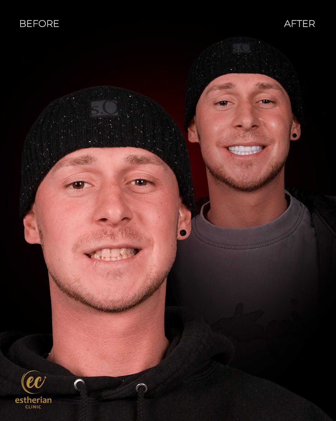 Smile Makeover Before After 6